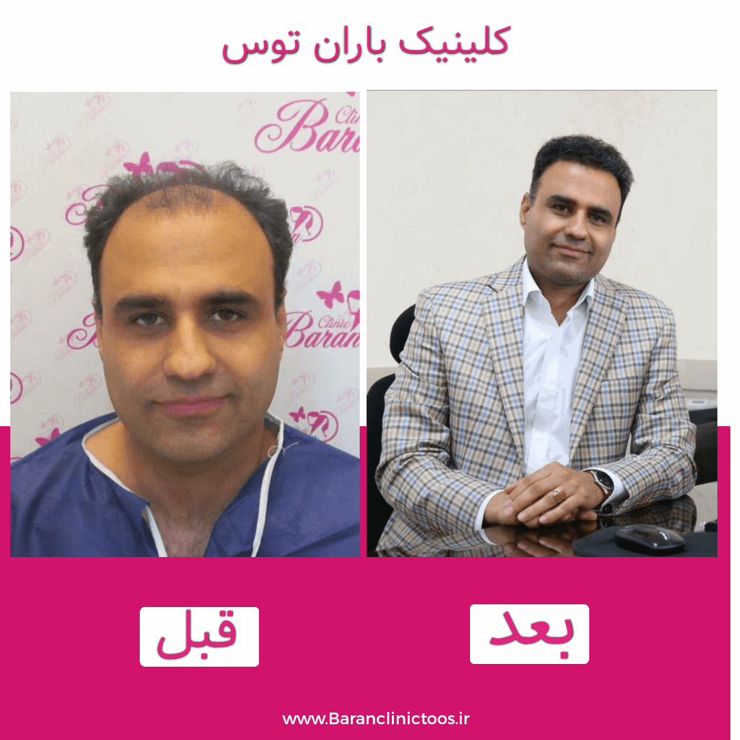 قبل و بعد کاشت مو